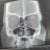 deviated septum