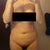 After (7 Days) - Front (not that's not a shadow around my pubic area...that's a bruise