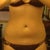 Front - 6 weeks post-procedure