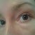 Puffy, swollen, botox eyes