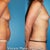 6 months post surgery