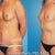 6 months post surgery