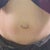 My huge umbilical hernia - can't wait to have a nice little belly button.