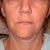 Facelift did not hold, doc did more lipo on my neck which he should of left the fat to fill in the loose skin.  This proceed was done with out my approval.