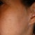 other ear is pixie,  hope to have this fixed sometime not willing to be put back under and loose more hair.