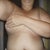 one week post op front view w/ surgical tape still on