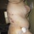 one week post op side view Bruising from Lipo