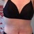 7.5 weeks post TT and BL
