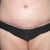 After - 4 weeks post-op tummy tuck and lipo