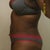 Side view 5 weeks post op