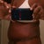 Side at 5 weeks after 2 weeks in compression garment