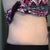 Bathing Suit After, Left (2 Weeks)