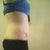 5wks post op side view