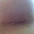 Scar @ 6 weeks. Still red, but totally smooth and no longer puckered. Shrinking considerably!