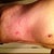 POST OP DAY 4