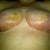 11 days post op