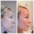 this is a pretty rough "before" pic of me but really shows what a difference with the profile and jawline! Should have done it a long time ago..