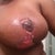 Oct 22nd - Left Breast. wound care nurse has me cleaning it with dial antibacterial soap. I put Silvasorb Gel on it and cover it with Kendall Curity oil emulsion dressing.