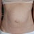 2.5 years before surgery - Front view