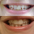 Before and After, Aligner 15