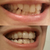 Before and After, Aligner 15 - left side
