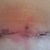 incision Healing really well feeling Great.