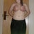 two weeks post op
