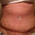 2.5 weeks po
Very Swollen