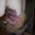 serious bruising..yikes