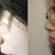 Before & After with glasses- the glasses on the 'after' photo are taped to my forehead since they aren't suppose to sit on my nose yet that's why they may appear a little bit higher than the 1st pic, but it's such a big improvement! =]