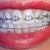 16-17 week Ortho-visit.  They added thicker wires extending to back teeth. Added chains to pull teeth back.