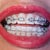 16-17 week Ortho-visit.  They added thicker wires extending to back teeth. Added chains to pull teeth back.  Not bad looking:)