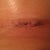 Incision under right breast