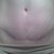 1 Year PO Front with Scar