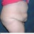 Right side 15 days before tt