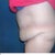 Left side 15 days before tt