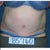 4 months PO, Front view, you can clearly see my pain pump poking out now, I hate that, but need it.