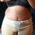 Pic 10--Wk11--post op TT