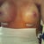 Photo #4: (Day 4) With the pre-op marks washed off. They look rather far apart, but the Dr. says with massage I can encourage more cleavage. :)
