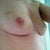 3 weeks since surgery, still slight bruising