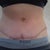 This is 13 days post op, seeing my scar for first time. I'm not sure what to think but it really looks ugly! I'm hoping it will smooth over.