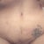 27 days,,,Standing up, close up of scar. Left side more swollen than right