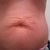 Pre Op belly