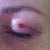 13 days post op, this is a scab that formed around a tiny opening that i had when i must have pulled a stitched out by accident. Letting it heal as is