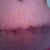 6 Wks PO: front of incision line. You can see how it migrated up. Hopefully those areas will lighten over time.