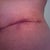 6 Wks PO: left side of TT incision.