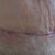 pic is just taking off the CG I wear at night to reduce the fluid build up you can see a little seeping,