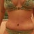 Post Opt Day 17 or 2 weeks 3 days