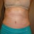 5 weeks post op
