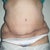 notice the scar is in a "diagonal" position and im super uneven everywhere